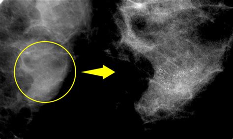 微細石灰化の集簇|マンモグラフィ検査で見られる石灰化病変について